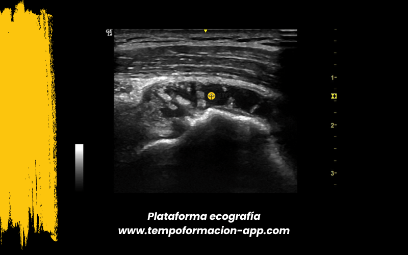 6. Ecografia tempo formacion manguito rotador tendon supraespinoso infraespinoso redondo menor subescapular.png